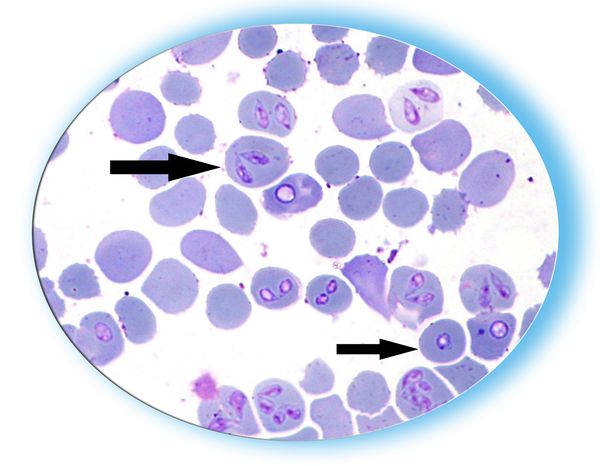 Babesiosis 1